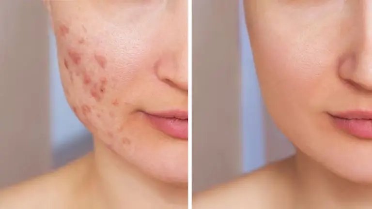 acne